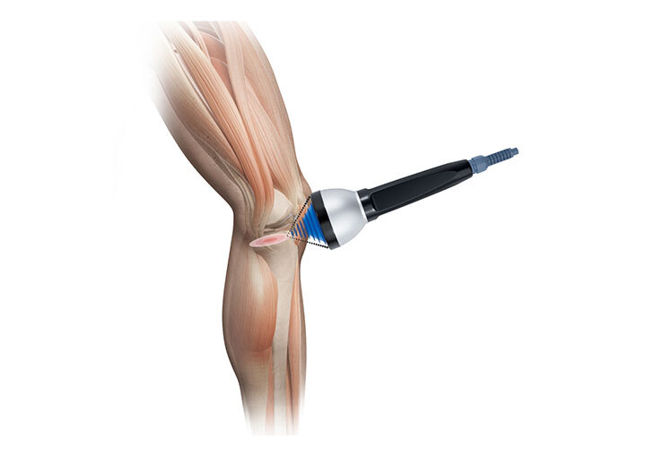 Modus eswt focused 0 orthopedics