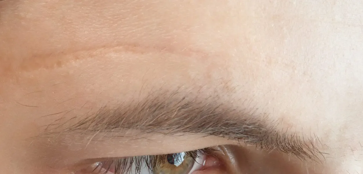 Can I remove facial scars with scar cream 1250x600