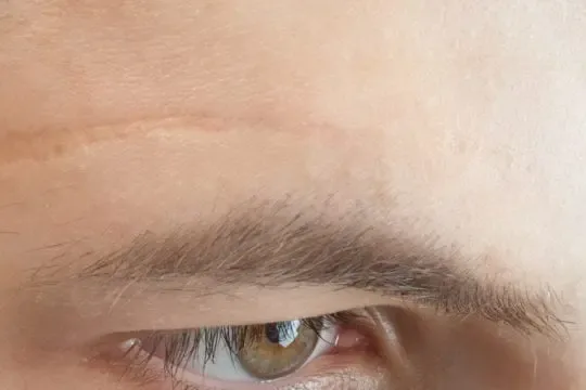 Can I remove facial scars with scar cream 540x360