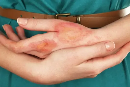 Preventing scars after a burn wound 540x360