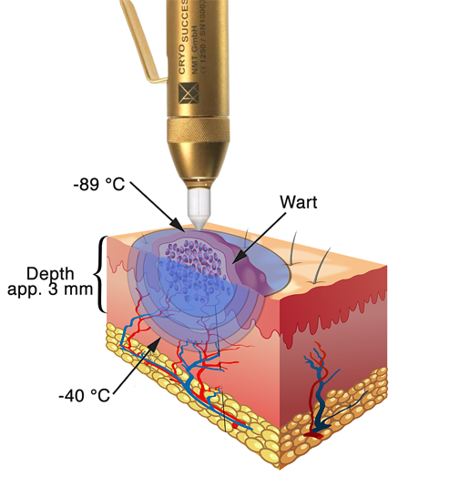 Cryosuccess lifestyle